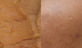 dry and hyperpigmented skin issues